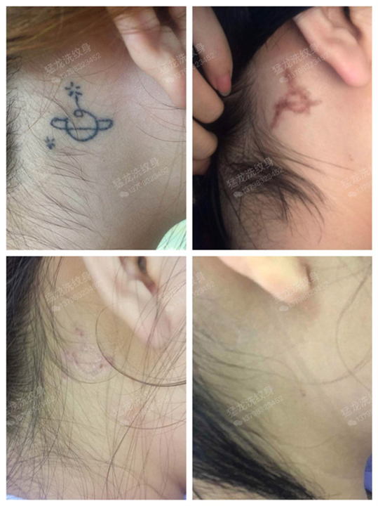 广州洗纹身
