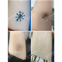 广州洗纹身找谁好广州专业洗纹身