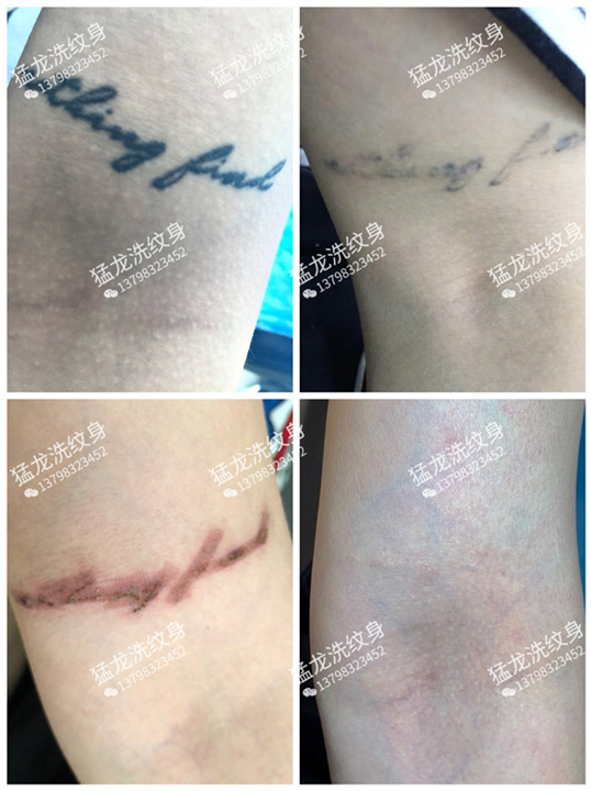 广州洗彩色纹身广州哪里可以洗纹身