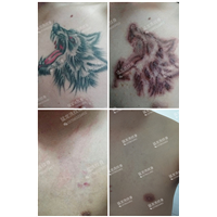 广州猛龙洗纹身万余例成功案例推荐