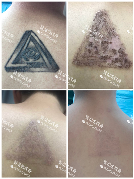 广州洗彩色纹身广州哪里可以洗纹身