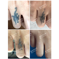 广州洗眉广州洗眼线