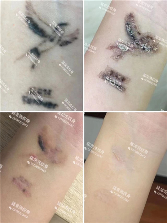 广州洗唇线广州哪里可以洗纹身