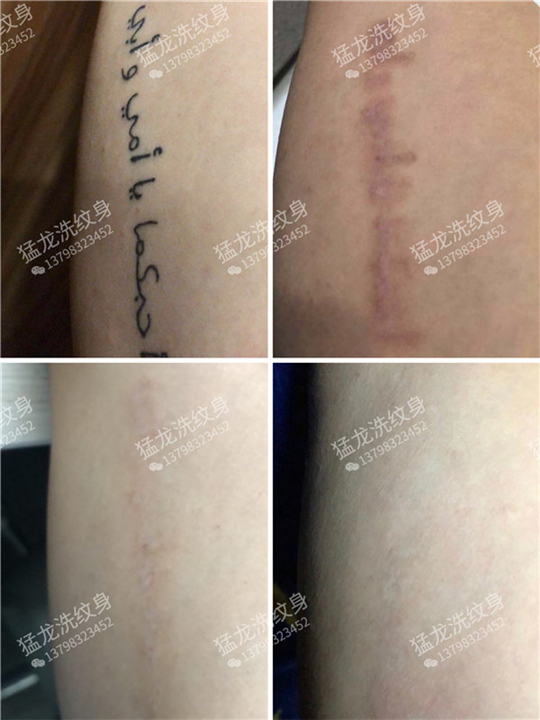 广州哪里可以洗纹身