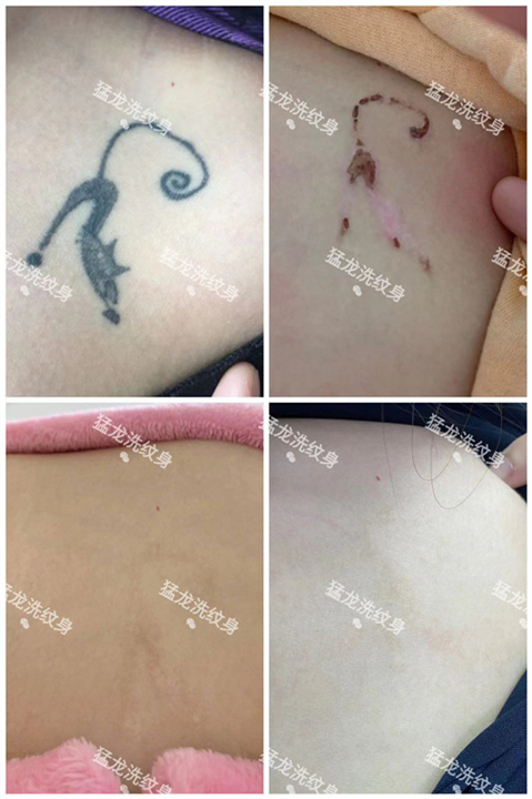 广州洗纹身用效果说话值得信赖的专业品牌