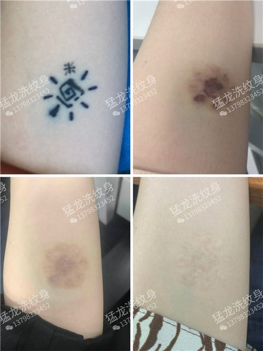 广州洗纹身找谁好广州专业洗纹身