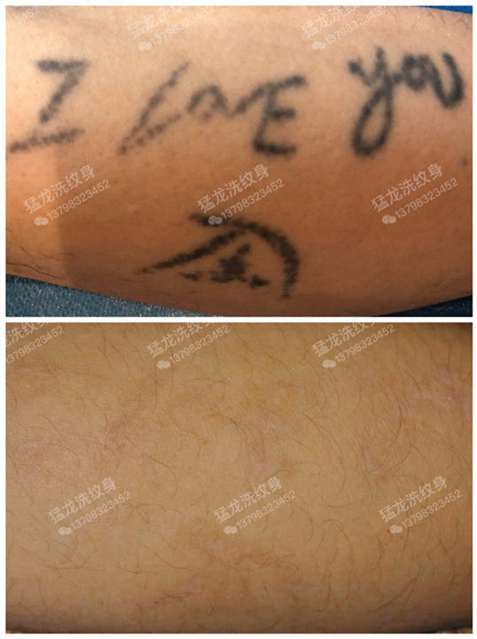广州洗纹身就到猛龙洗纹身安全有保障