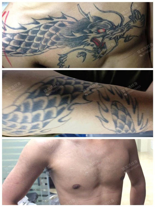 广州洗纹身