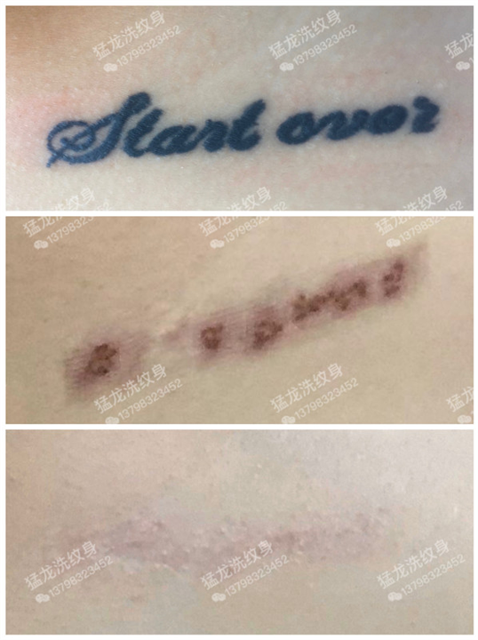 广州洗纹身不留疤效果好收费正规
