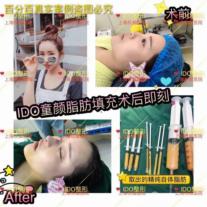 上海脂肪填充整形医院 