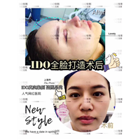 上海全脸打造术后 