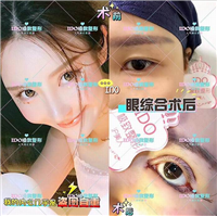 上海眼部整形 
