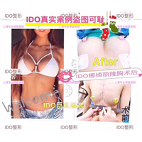 上海丰胸整形 