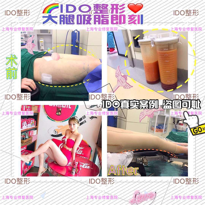 上海整形大腿吸脂案例 