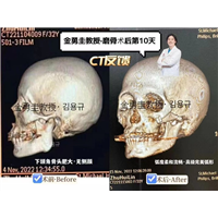 金勇圭教授磨骨术后10天