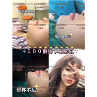 上海假体下巴整形 