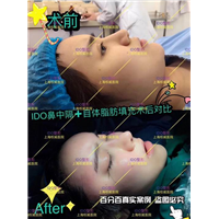 上海脂肪填充整形医院 