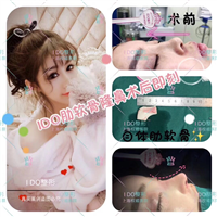 上海隆鼻整形 