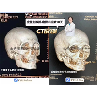 金勇圭磨骨术后反馈