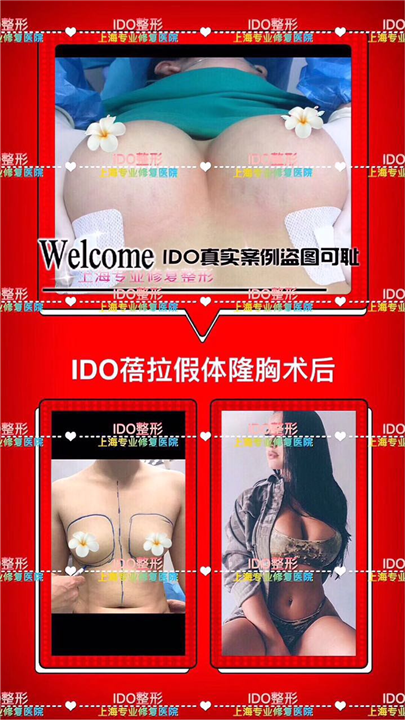 上海隆胸整形 