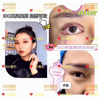 上海双眼皮整形 