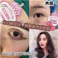 上海眼部整形 