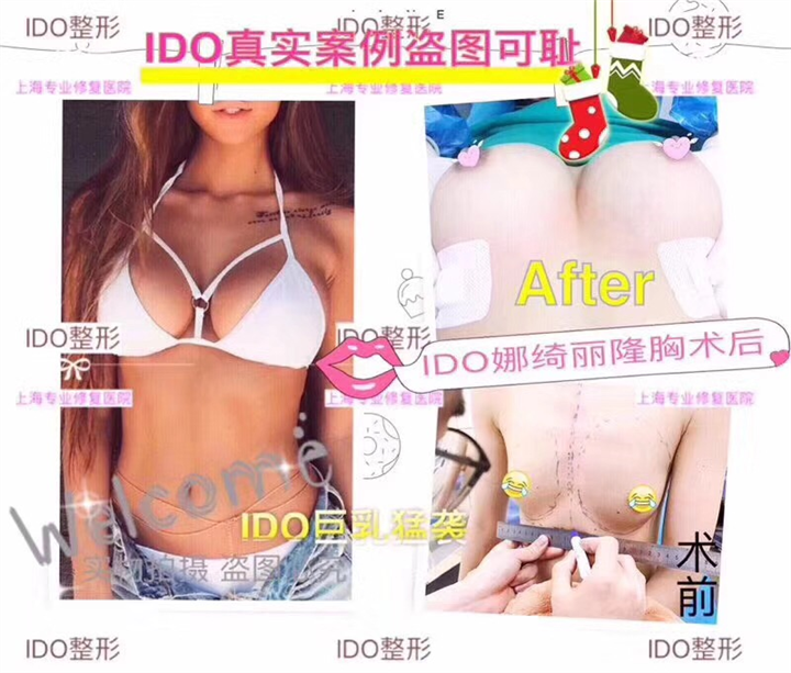 上海丰胸整形 