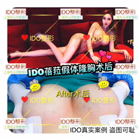 隆胸整形医院 