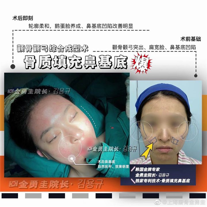 骨质填充鼻基底