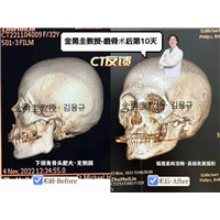 金勇圭下颌角怎么样