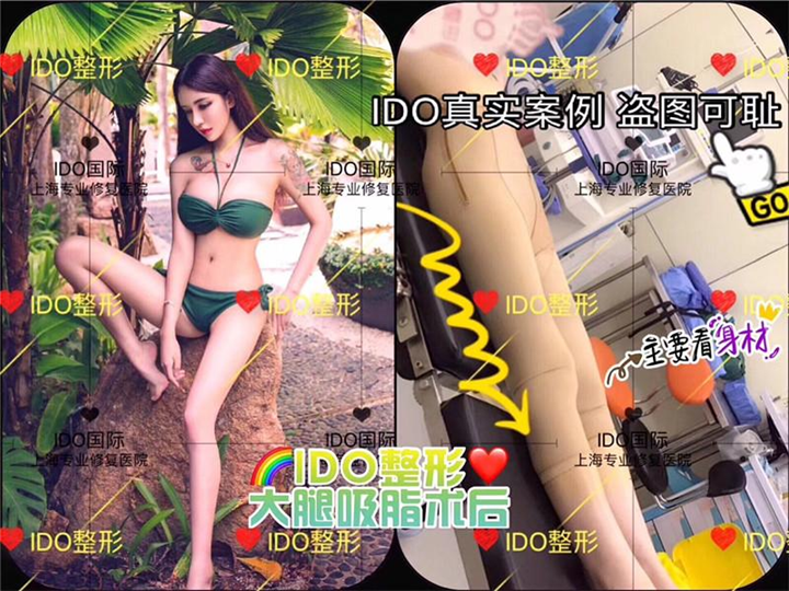 上海大腿抽脂案例 