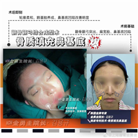 骨质填充鼻基底
