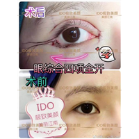 上海眼部整形 