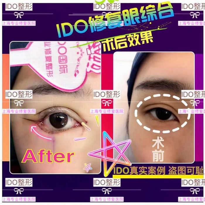 眼综合整形 