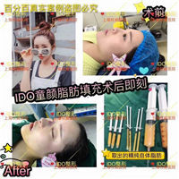 上海脂肪填充整形医院 
