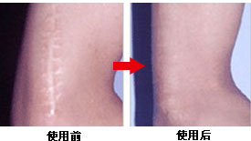 西宁哪里可以去疤痕