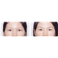 纹眉前后图 