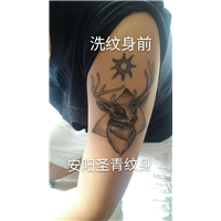 安阳洗纹身|安阳洗纹身前后对比