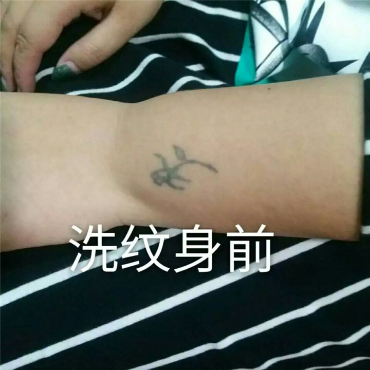 安阳洗纹身|安阳洗纹身哪家好