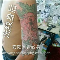 安阳洗纹身|安阳洗纹身效果