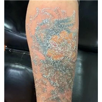 安阳洗纹身/安阳洗纹身哪里好