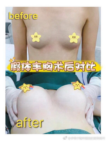 安徽网红全脸打造|安徽自体肋骨隆鼻整形