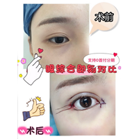 安徽眼综合整形|安徽脂肪填充