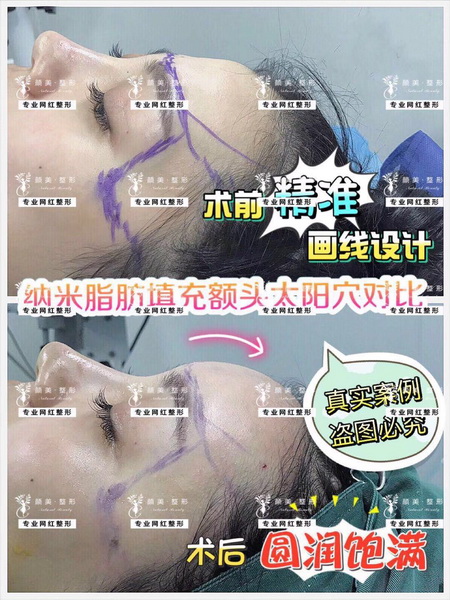 安徽人气网红整形|安徽鼻综合整形