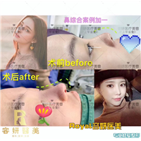 上海鼻整形哪家好 
