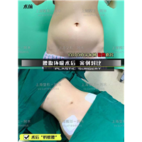 上海美丽之星整形医院腰腹吸脂