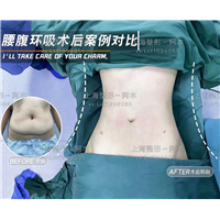 上海美丽之星整形腰腹环吸术后案例