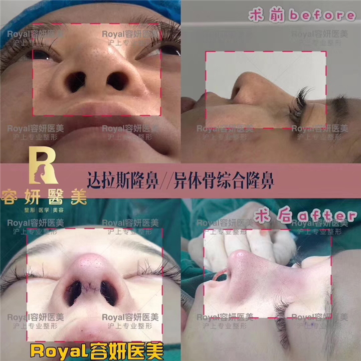 上海鼻整形医院 