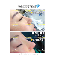上海隆鼻整形 