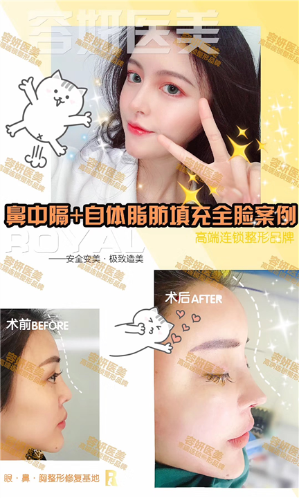 上海鼻整形修复多少钱 